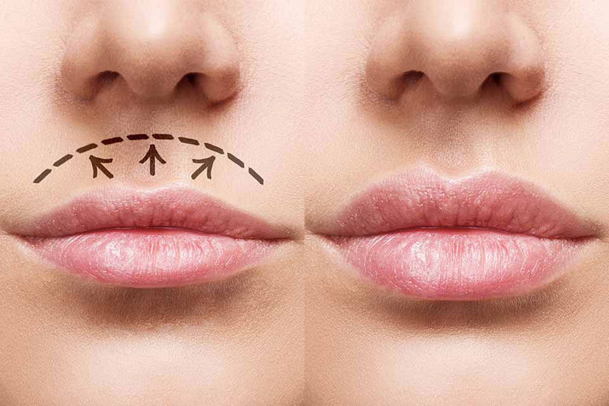 جراحی سانترال لب 