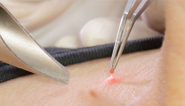 برداشتن خال و زگیل 